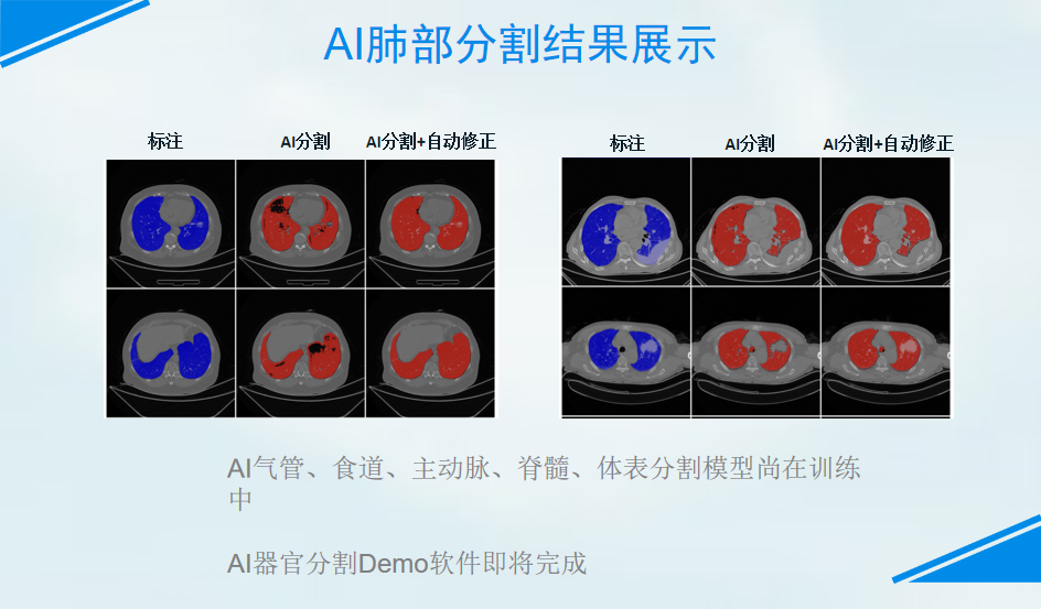 人工智能放疗